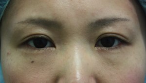 奥二重から平行型二重へ