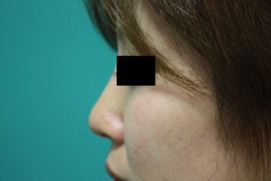 鼻のプチ整形は美人への近道