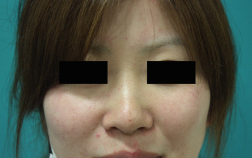 鼻プチ整形前正面width=500 鼻プチ整形前正面