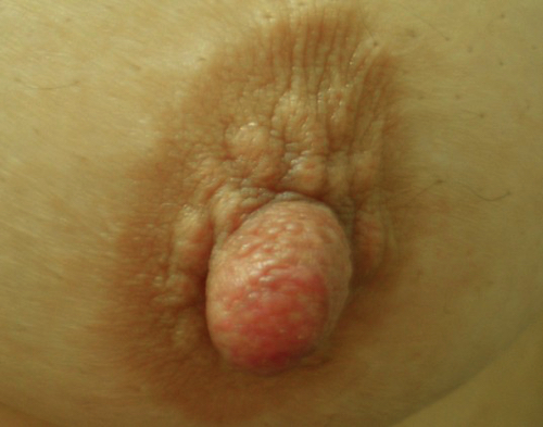 乳頭縮小手術前width=500 火乳頭縮小手術前