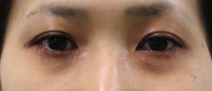 二重手術の第一選択は埋没法です！