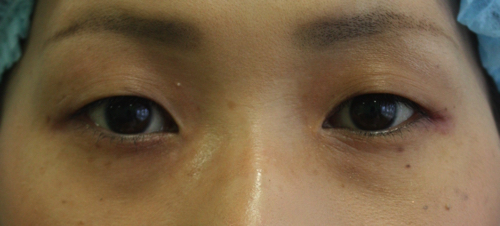二重埋没法施述前width=500 二重埋没法施述前