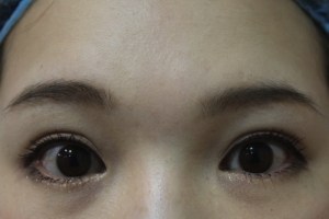 下まつ毛の逆さまつ毛治療