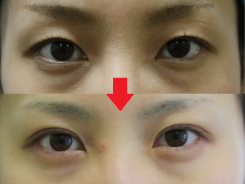 二重埋没法の跡がまぶたに残るか？