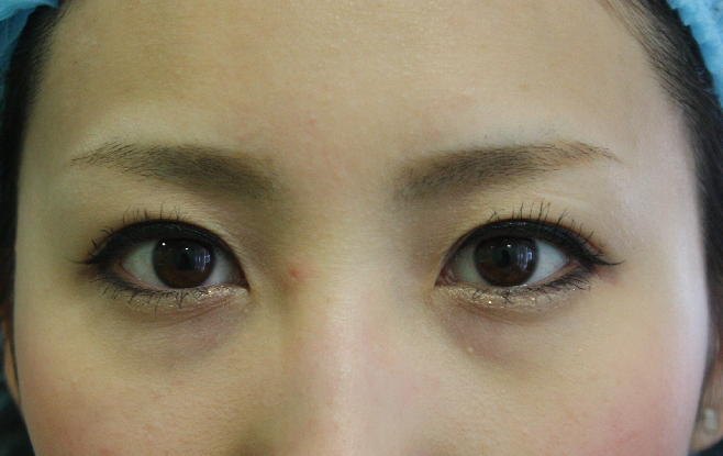 二重まぶた治療後メイク