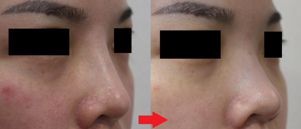 鼻のヒアルロン酸を溶かしたい時はヒアルロン酸分解注射
