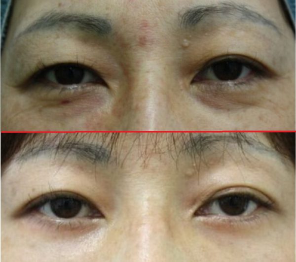 目の下のクマ・たるみに対してのベストな治療法とは？