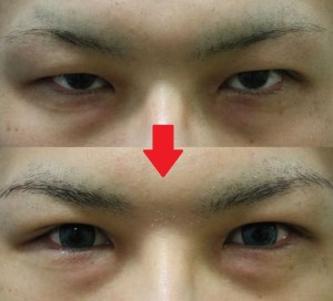 男性の二重まぶた整形治療