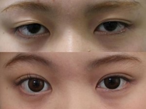 軽度の眼瞼下垂は埋没法で治ります！