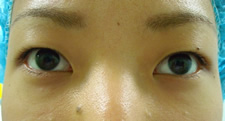 case_eye2_001