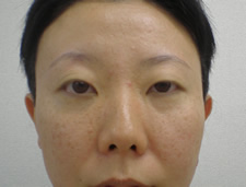 case_eye2_007
