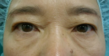case_eye2_014