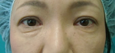 case_eye2_016