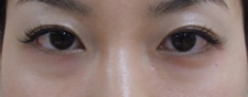 case_eye2_018