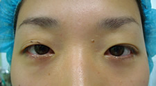 case_eye2_023