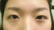 case_eye2_024