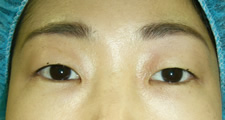 case_eye2_025