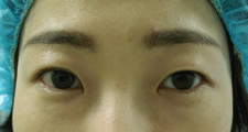 case_eye2_026