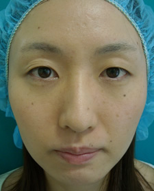 case_eye2_027