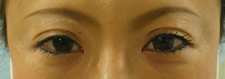 case_eye3_001