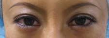 case_eye3_002