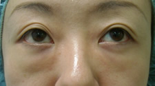 case_eye_001