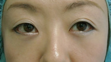 case_eye_002