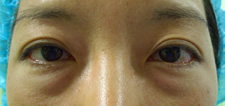 case_eye_003