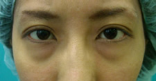 case_eye_005