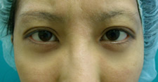 case_eye_006