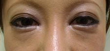 case_eye_007