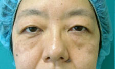 case_eye_009