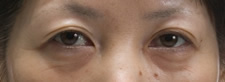 case_eye_011
