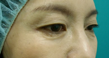 case_face2_024