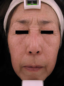 case_face2_032