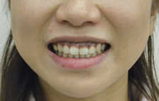 case_face6_005
