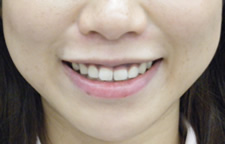 case_face6_006