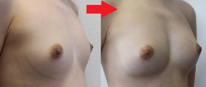 最善の豊胸治療はアクアフィリング