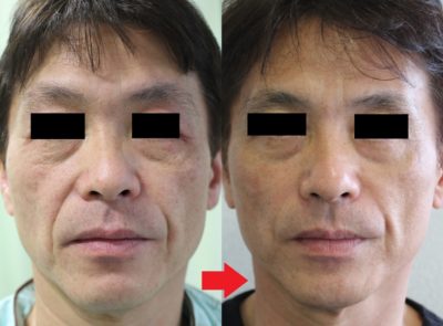 中年男性におすすめの若返り治療!【スプリングスレッド編】