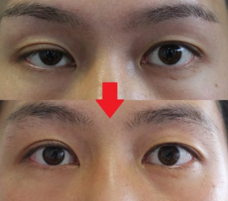 片目の生まれつきの眼瞼下垂