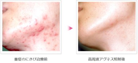 最新のニキビ治療「アグネス」大人気です!