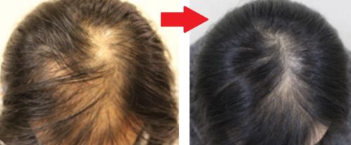 女性薄毛のご相談、たくさんいただいております！