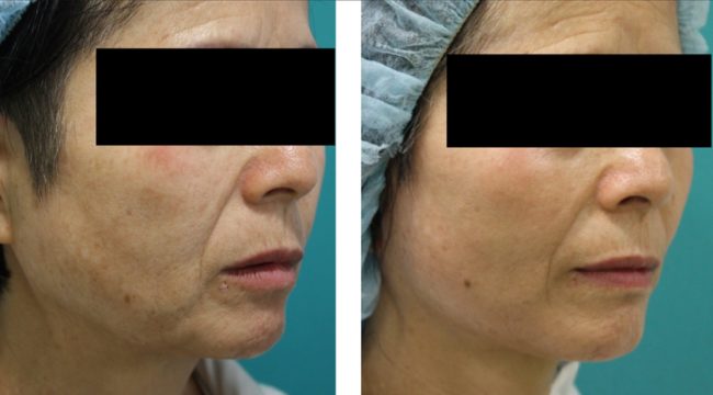 フェイスリフト手術|加齢によるたるみを劇的改善【症例写真あり】