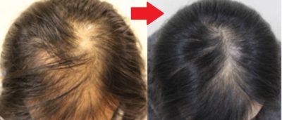 女性専用の薄毛注射治療『ヘアーバース注射』の劇的効果