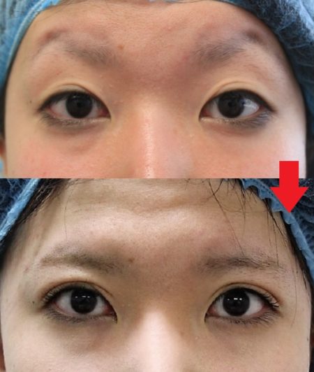 糸で留める「切らない眼瞼下垂手術」