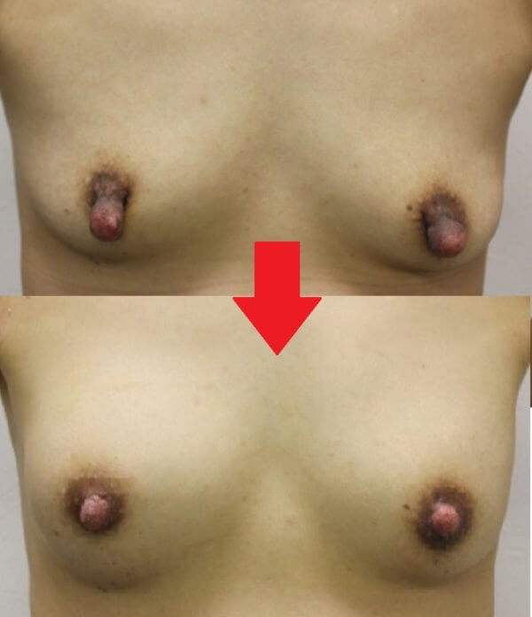 乳頭縮小手術がおすすめです！