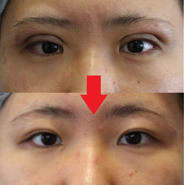 腫れが凄く出てしまった二重埋没法の例