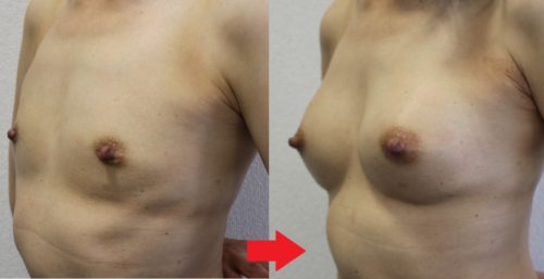 授乳後のバストにアクアフィリング豊胸300㏄