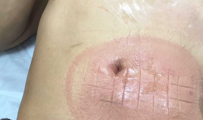 脂肪冷却後の赤み
