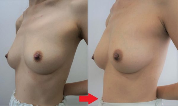 バストがもともと綺麗なのに、豊胸?